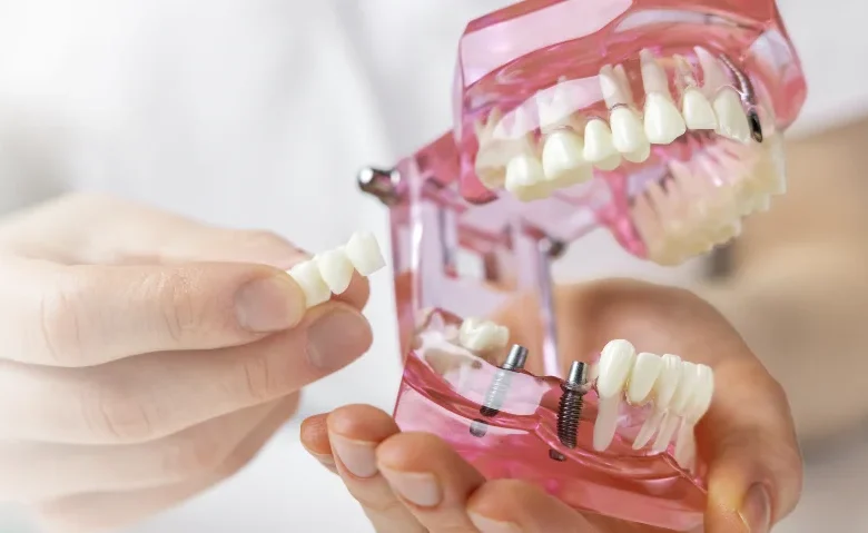 How Do Dental Implants Compare to Bridges or Dentures?